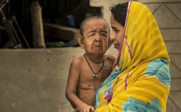 সেই ‘বৃদ্ধ’ শিশু বায়েজিদ ঢামেক হাসপাতালে ভর্তি